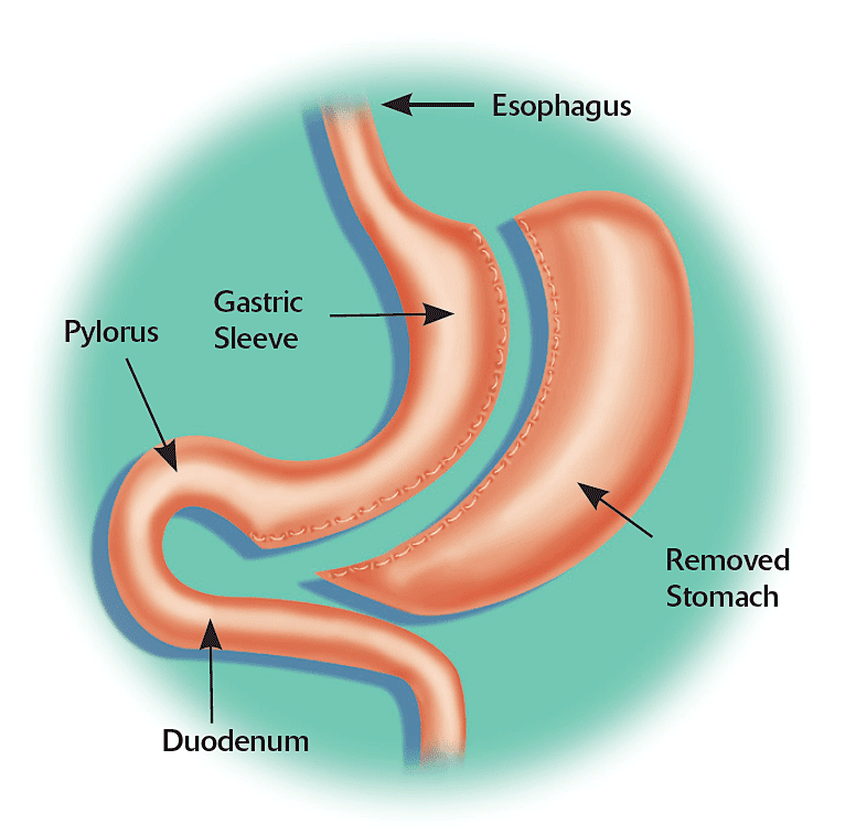Important Tips for Gastric Sleeve Diet after Surgery Diet Weight Loss