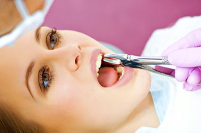 Tại sao phải nhổ răng khi niềng răng?