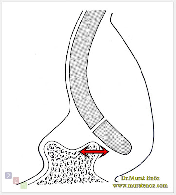 Caudal Septum Deviation / Dislocation