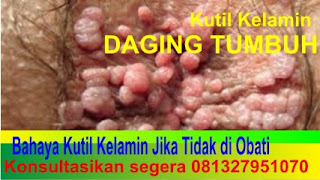 Obat Kutil Daging Tumbuh di Kelamin Paling ampuh