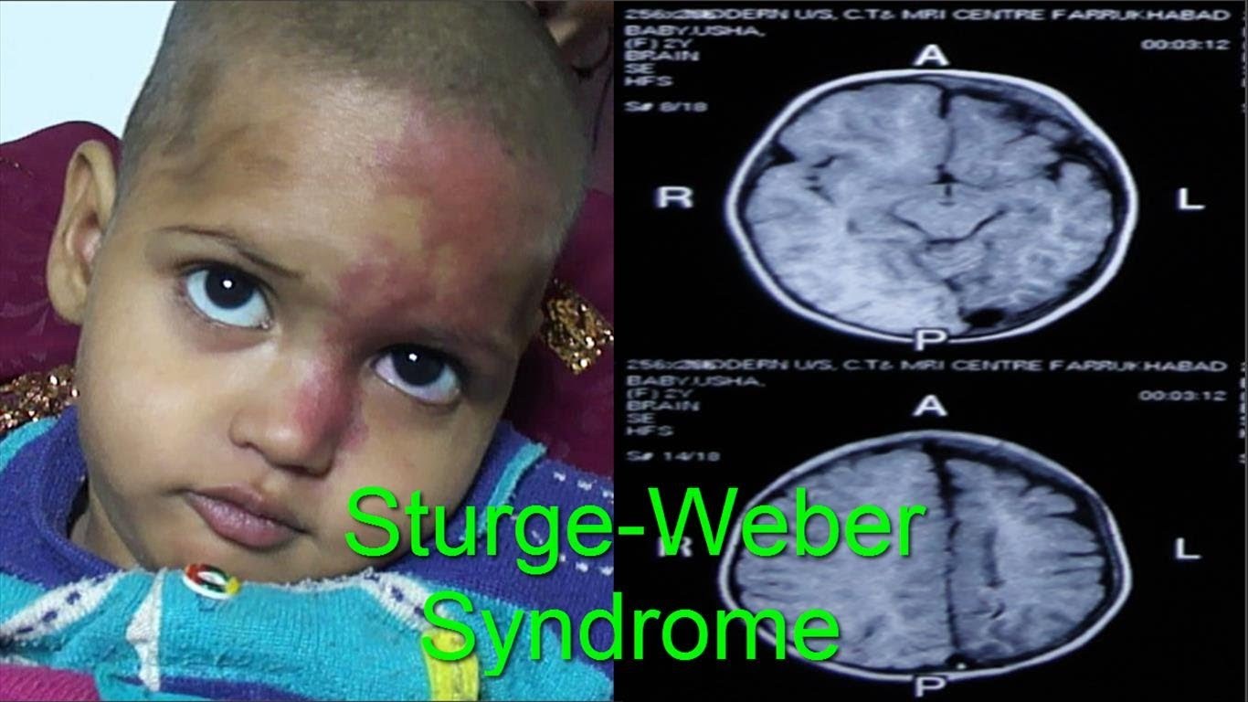 SturgeWeber syndrome