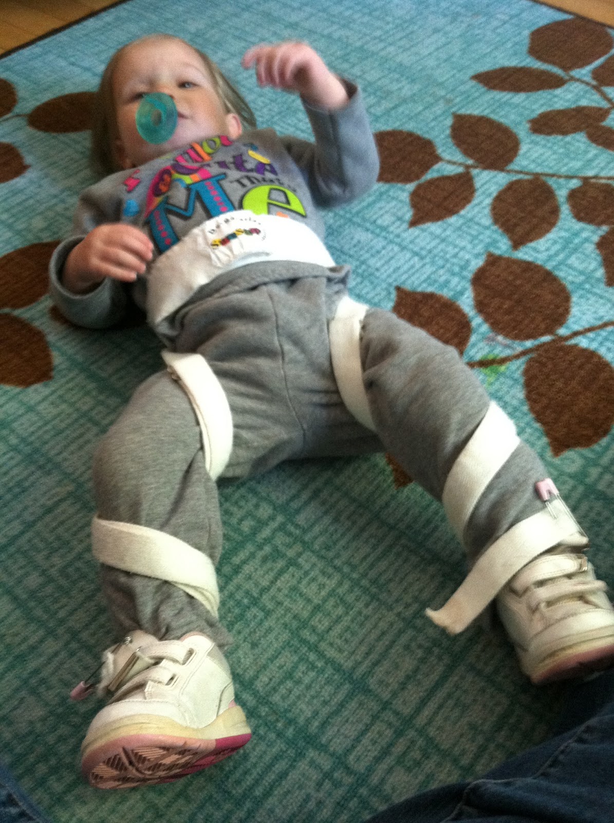 Rachel's Journey with Spina Bifida DeRotation Straps Tutorial