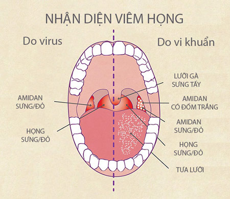 Nhận diệm Viêm Họng Hạt nhan-dien-viem-hong-hat