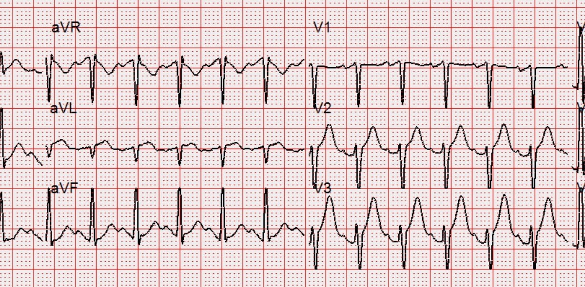Dr. Smith's ECG Blog Crushing Chest pain, Tachycardia, and Very