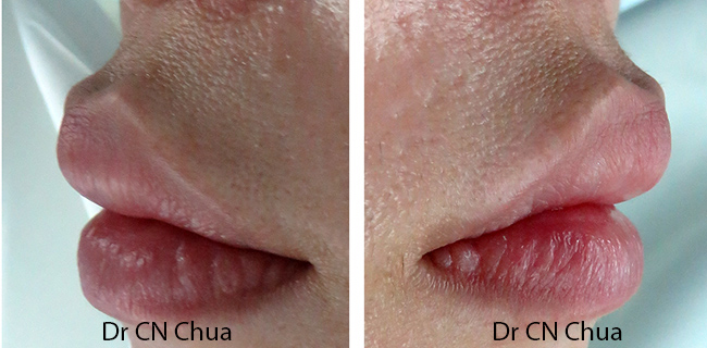 Eyelid Surgery by Prof Dr CN CHUA 蔡鐘能: 2016