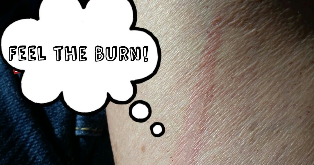 Randomocity Feel the Burn?