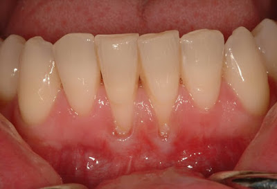 Chân răng bị hở do nguyên nhân nào