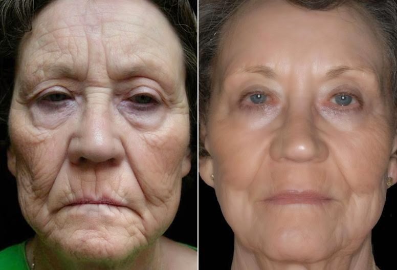 Can Micro-Needling Improve the Appearance of Wrinkles and ...