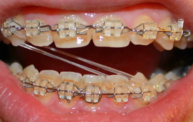 gross braces rubber bands