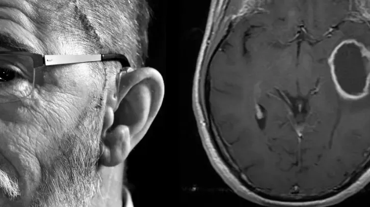 ما هو سرطان الدماغ من الدرجة الرابعة