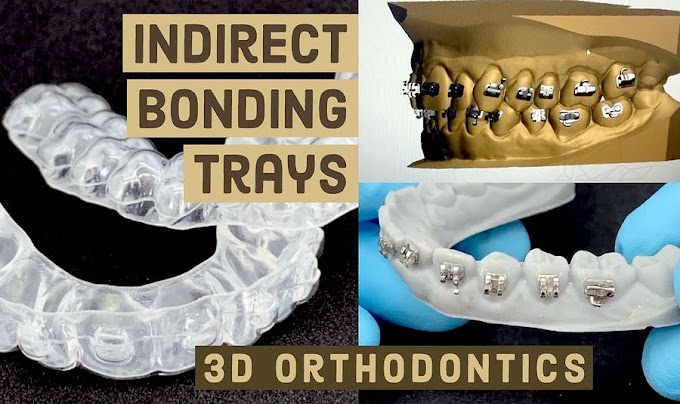 ORTHODONTICS: Indirect Bonding Trays - 3D