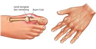 Penyebab Asam Urat Dan Pencegahannya  Asam urat adalah hasil metabolisme ikatan kimia yang mengandung nitrogen yang terdapat da Penyebab Asam Urat Dan Pencegahannya