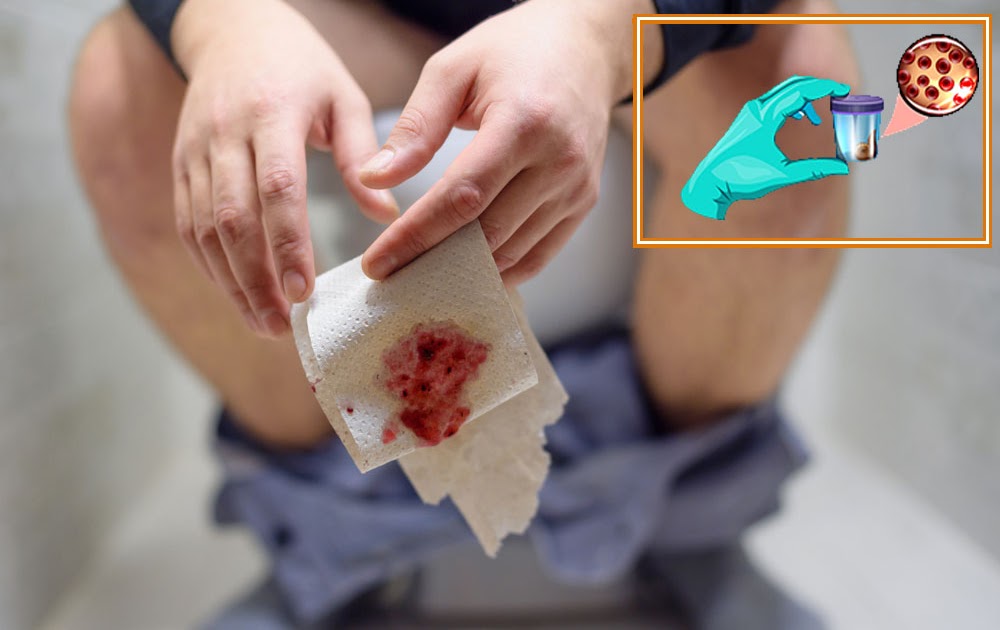 Blood in Stool