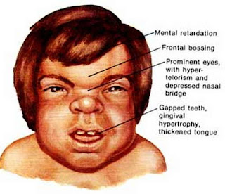 Hurlers Syndrome Pictures | Medical Pictures and Images - (2023 Updated)