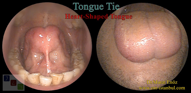 Heart-Shaped Tongue