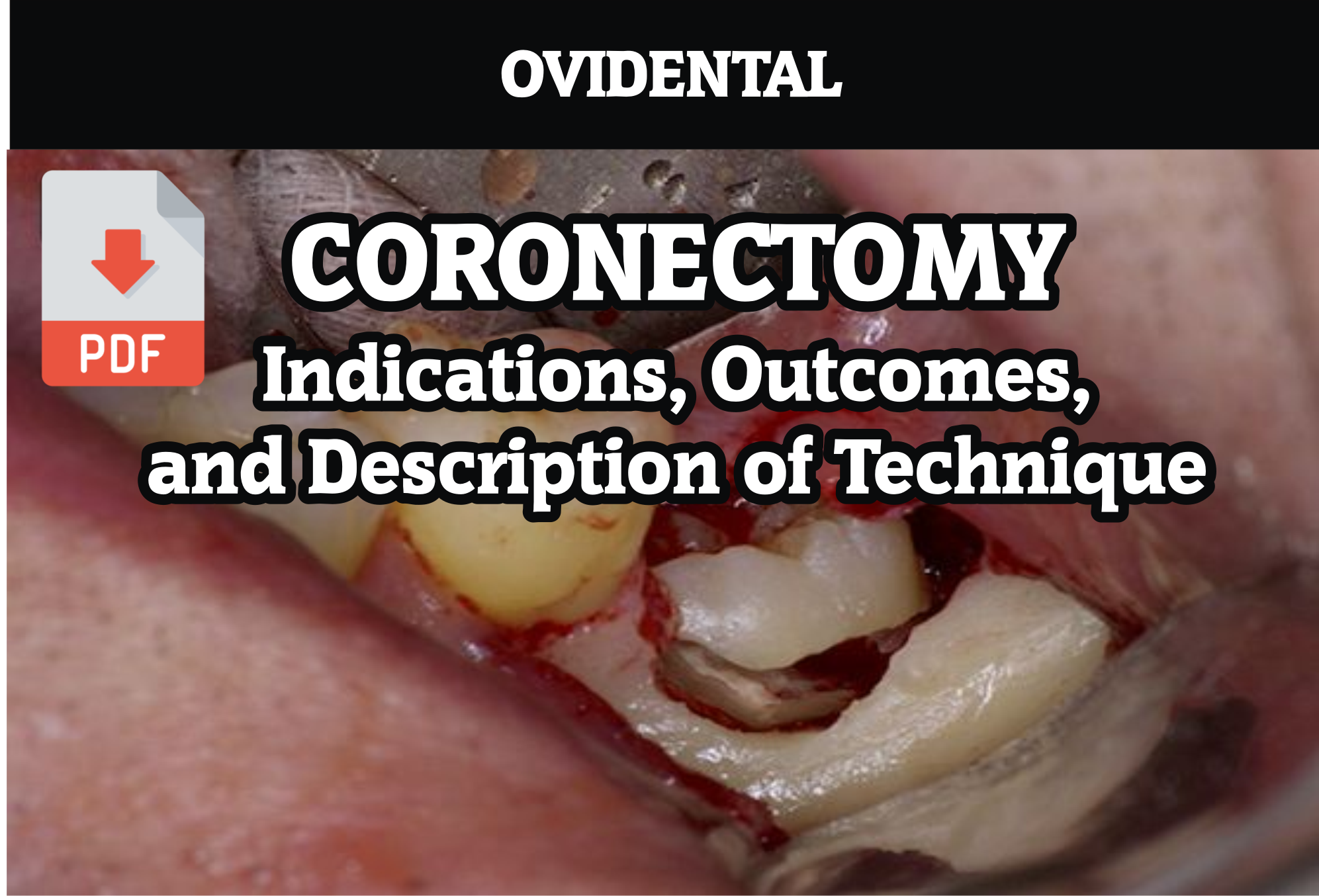 PDF Coronectomy Indications, and Description of Technique