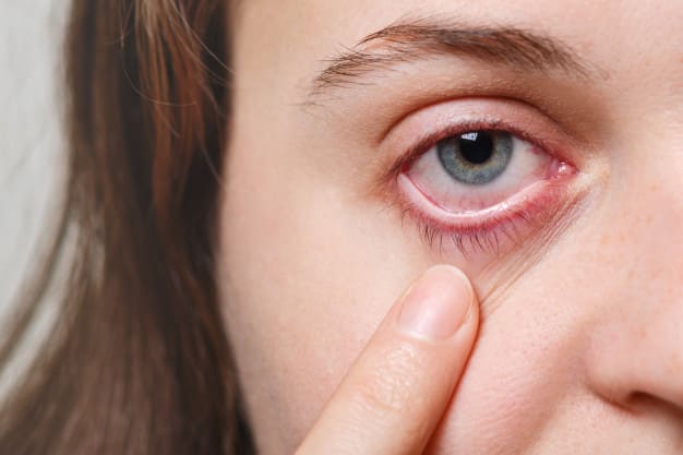 What is the treatment of redness of the eyes after sleep ? redness of the eye bloodshot eyes lumify bloodshot eye on one side red veins in eyes red eyes causes dogs eyes red red eyelids bloodshot eyes meaning red eye contacts