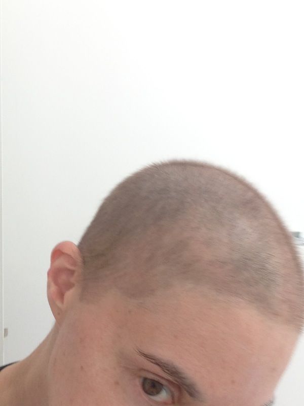 Chemo Biyatch MAKING LEMONADE OUT OF A BALD HEAD
