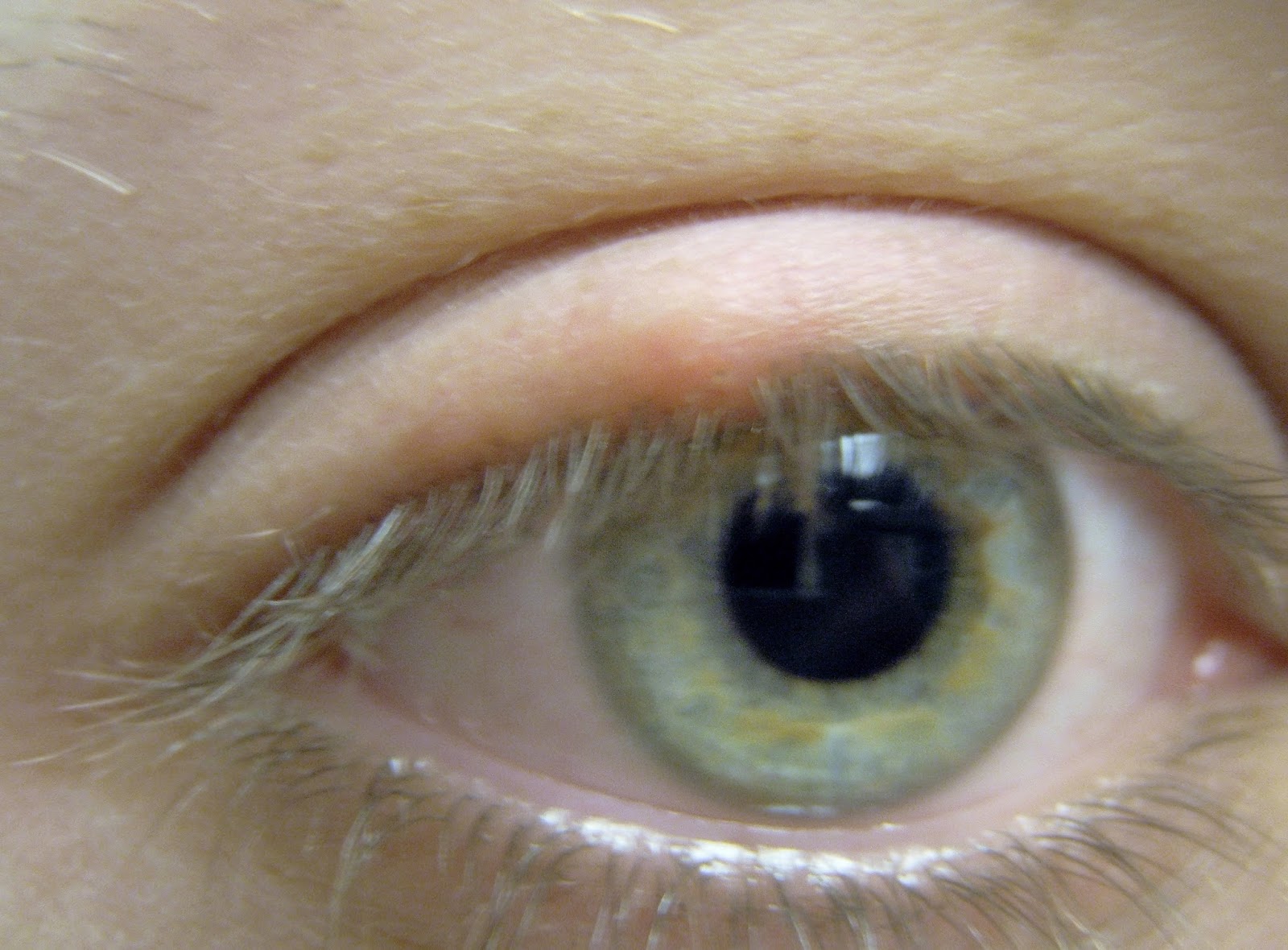 red-bump-on-lash-line-ingrown-eyelash-pictures-treatments-and-prevention