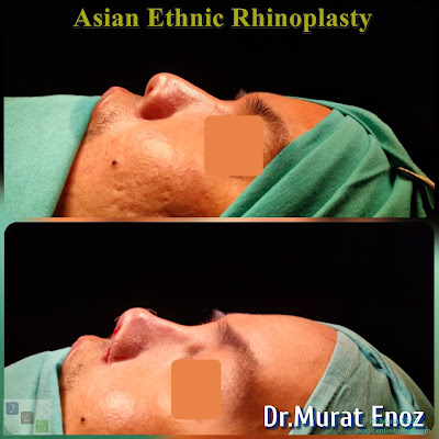 Asian Ethnic Nose Job in Istanbul - Asian Rhinoplasty