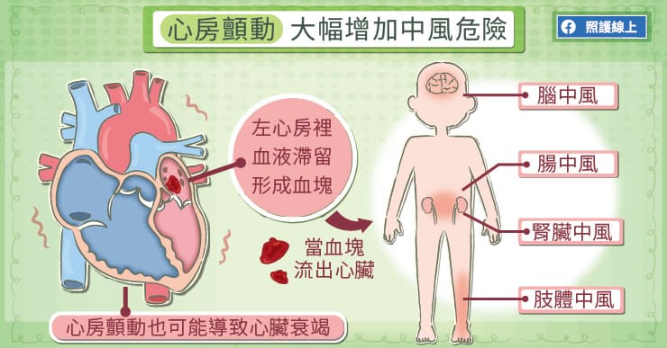 心房顫動會大幅提高中風的機率