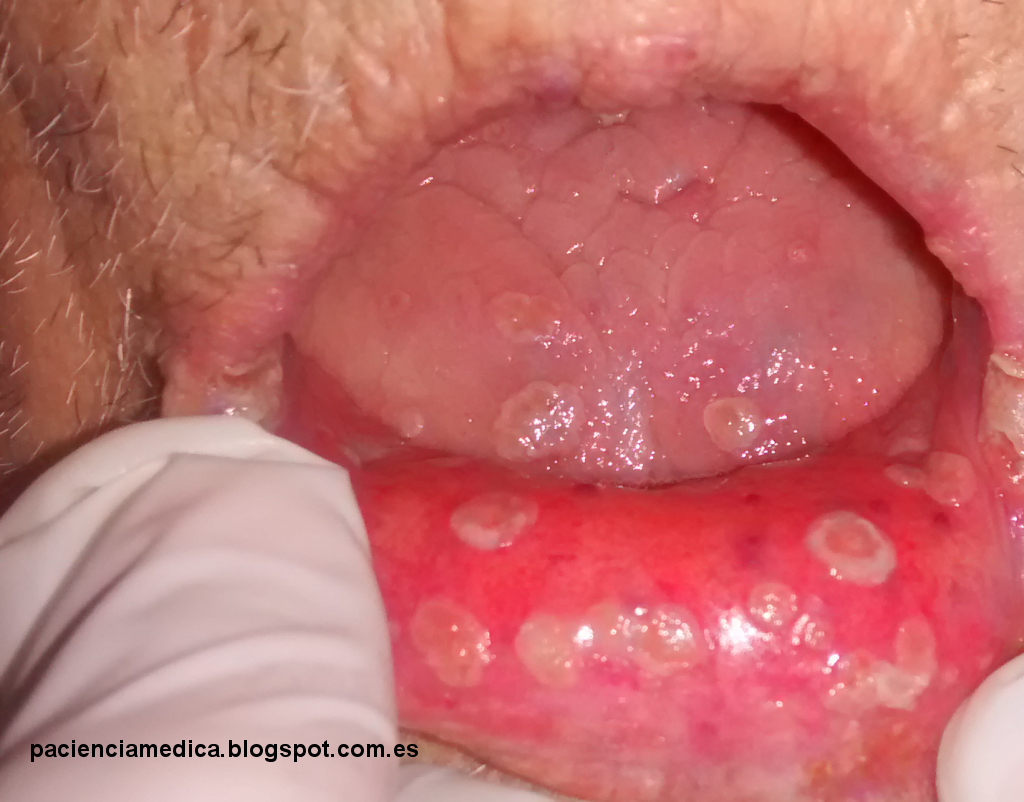 lip herpes #11