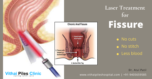 advanced treatment for fissure, Anal Fissure, chronic fissure, fissure, Laser Treatment for Fissure, laser treatment for fissure in Pune, Laser treatment of fissures, Lateral Sphincterectomy,