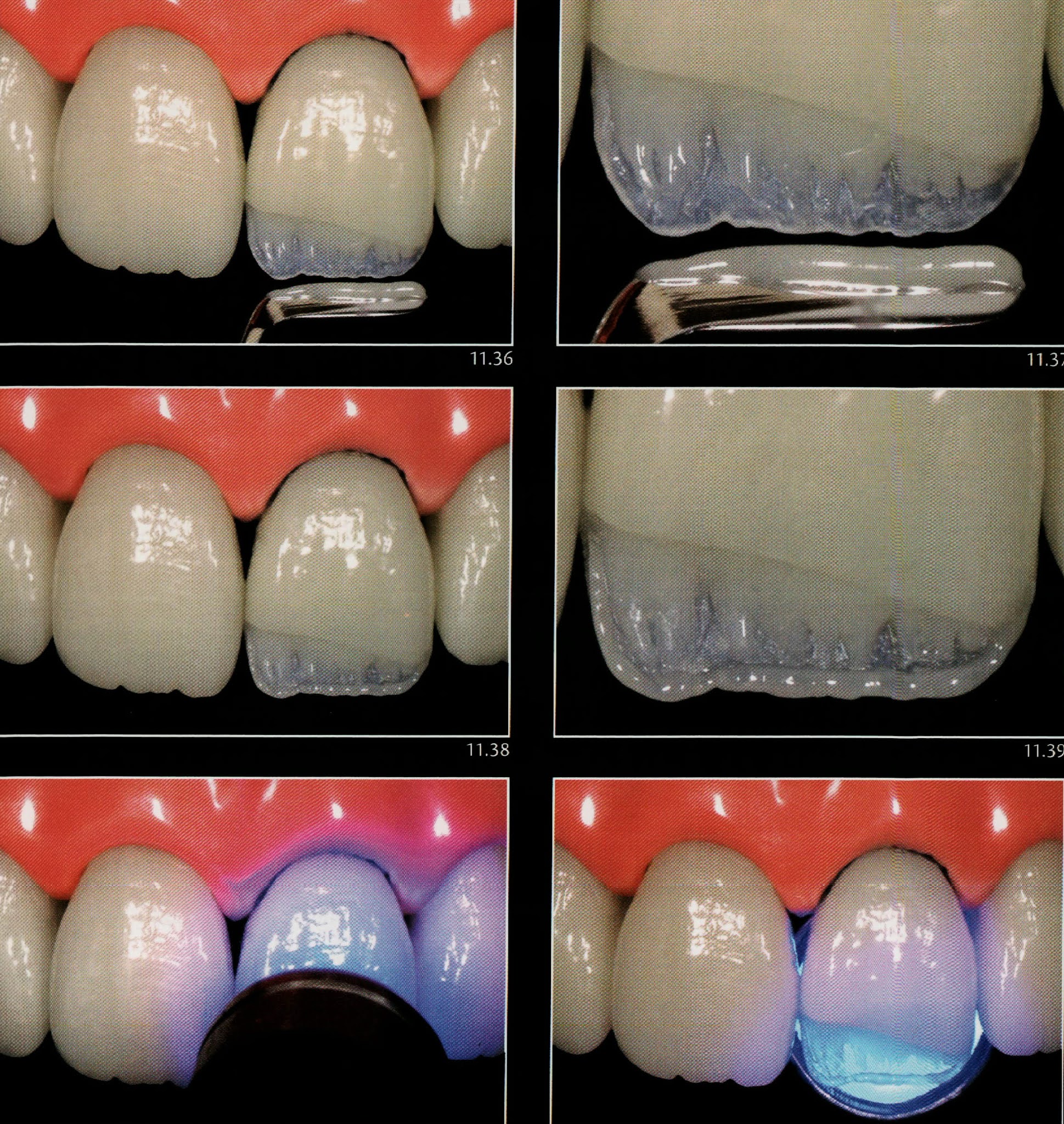 Class IV composite " silicone guide technique " Dental Esthetics