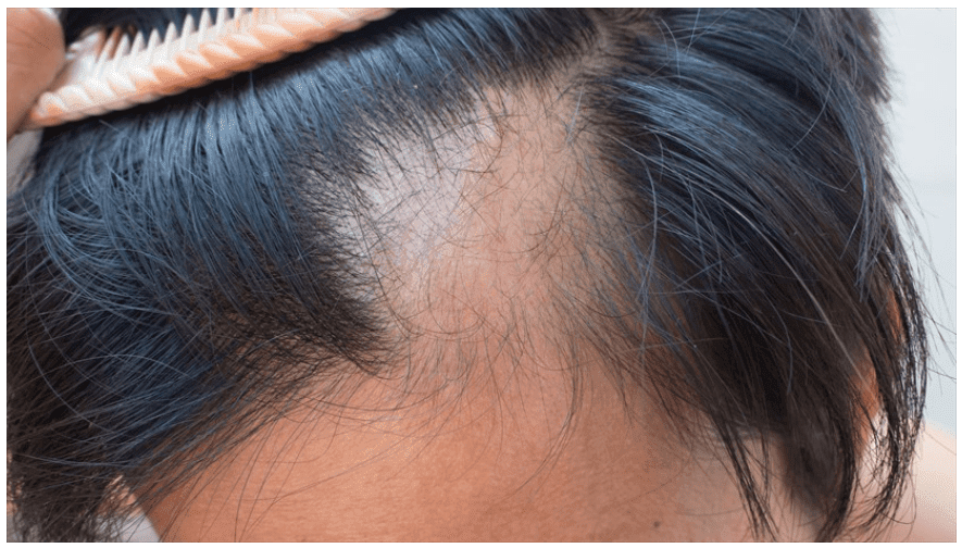 How To Cover Bald Spots And Some Causes Of Hair Loss
