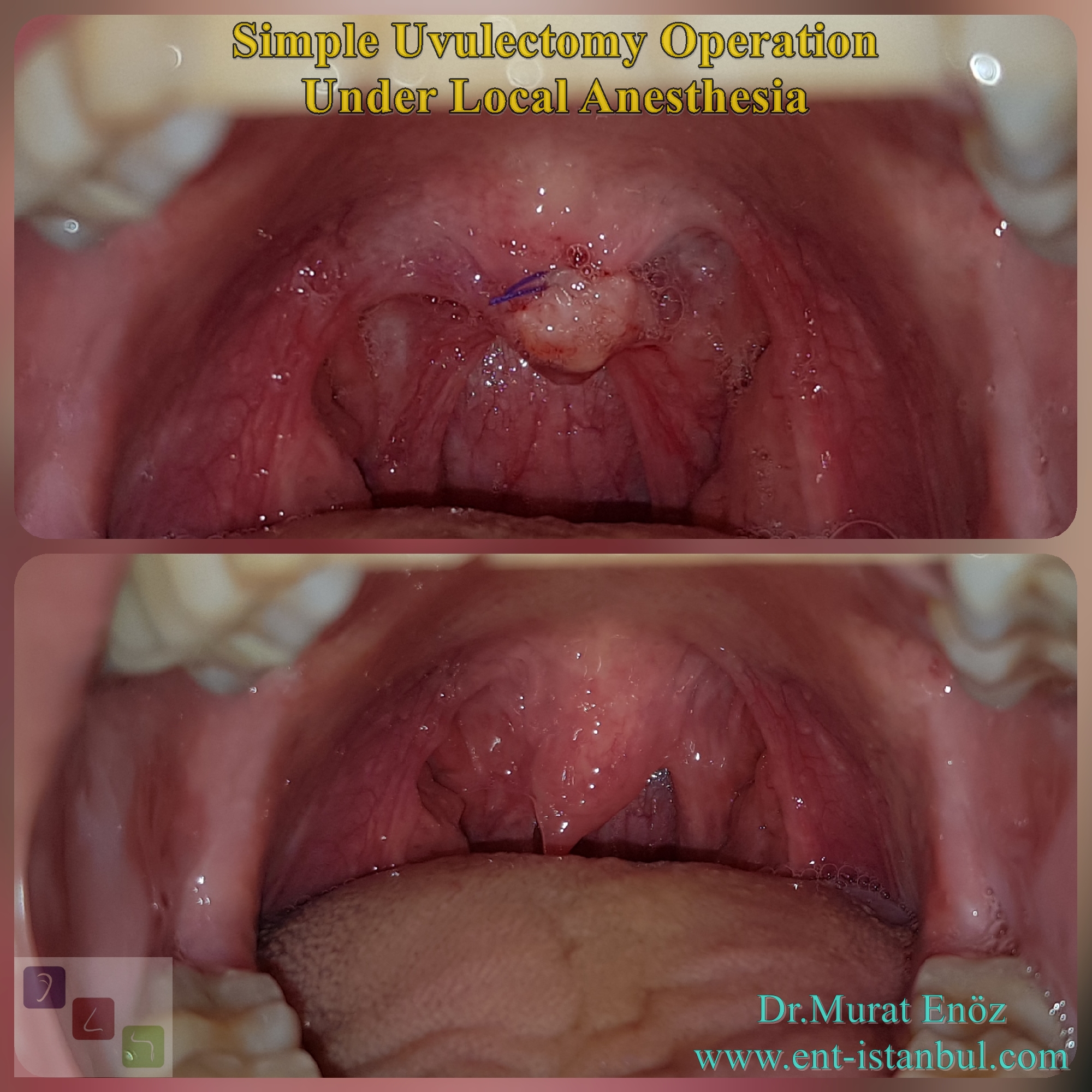 Uvula Pulling To One Side mapageprek