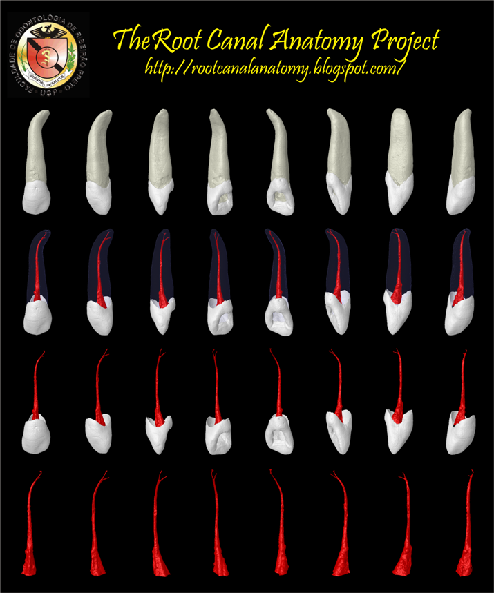 The Root Canal Anatomy Project Maxillary Lateral Incisor