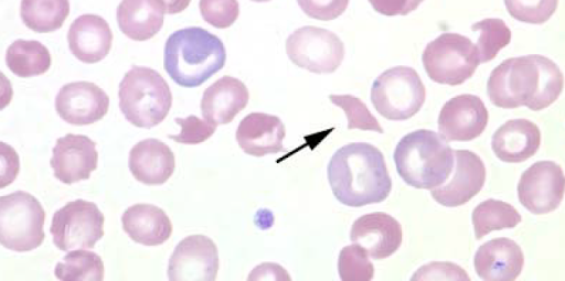 كريات الدم الحمراء المجزأة schistocyte