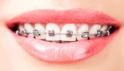 Niềng răng điều trị khiếm khuyết cho răng