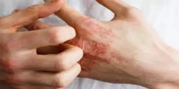 How to reduce the discomfort if you have itchy skin
