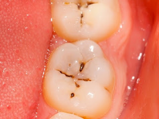 Cách điều trị răng chớm sâu nào tốt nhất?