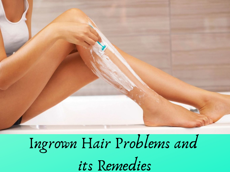 Ingrown Hair Natural Ways To Get Rid Of Them Easily Shongruff