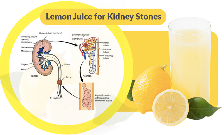 Here's How To Use Lemon To Fight Kidney Stones Prevention Is Better