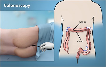 Why did my doctor recommend colonoscopy? - What symptoms indicate a need for a colonoscopy?