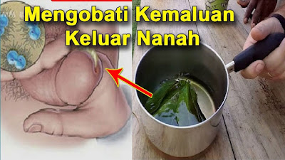 Obat Kencing Keluar Nanah Nyeri dan Sakit untuk Pria