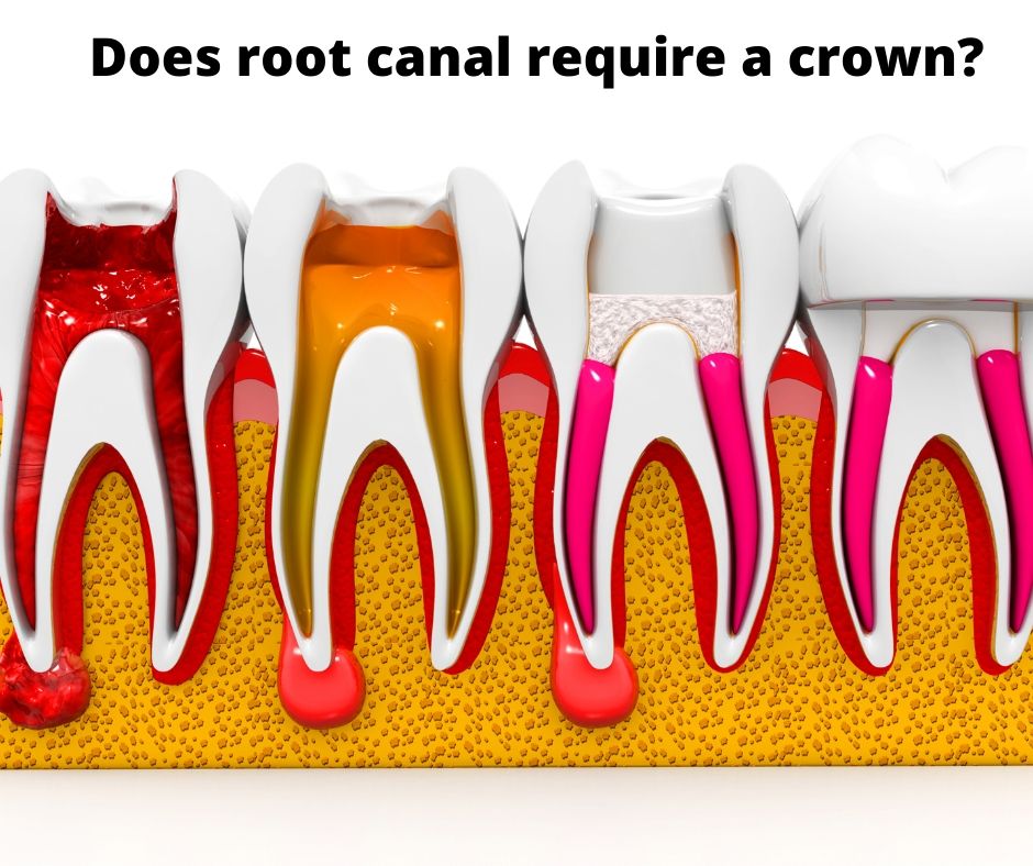 Does Root Canal require a crown?