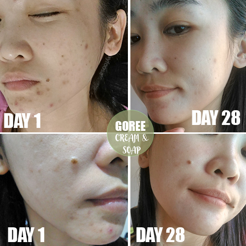 Goree Cream and Soap Review Can It Effectively Vanish Your Acne and