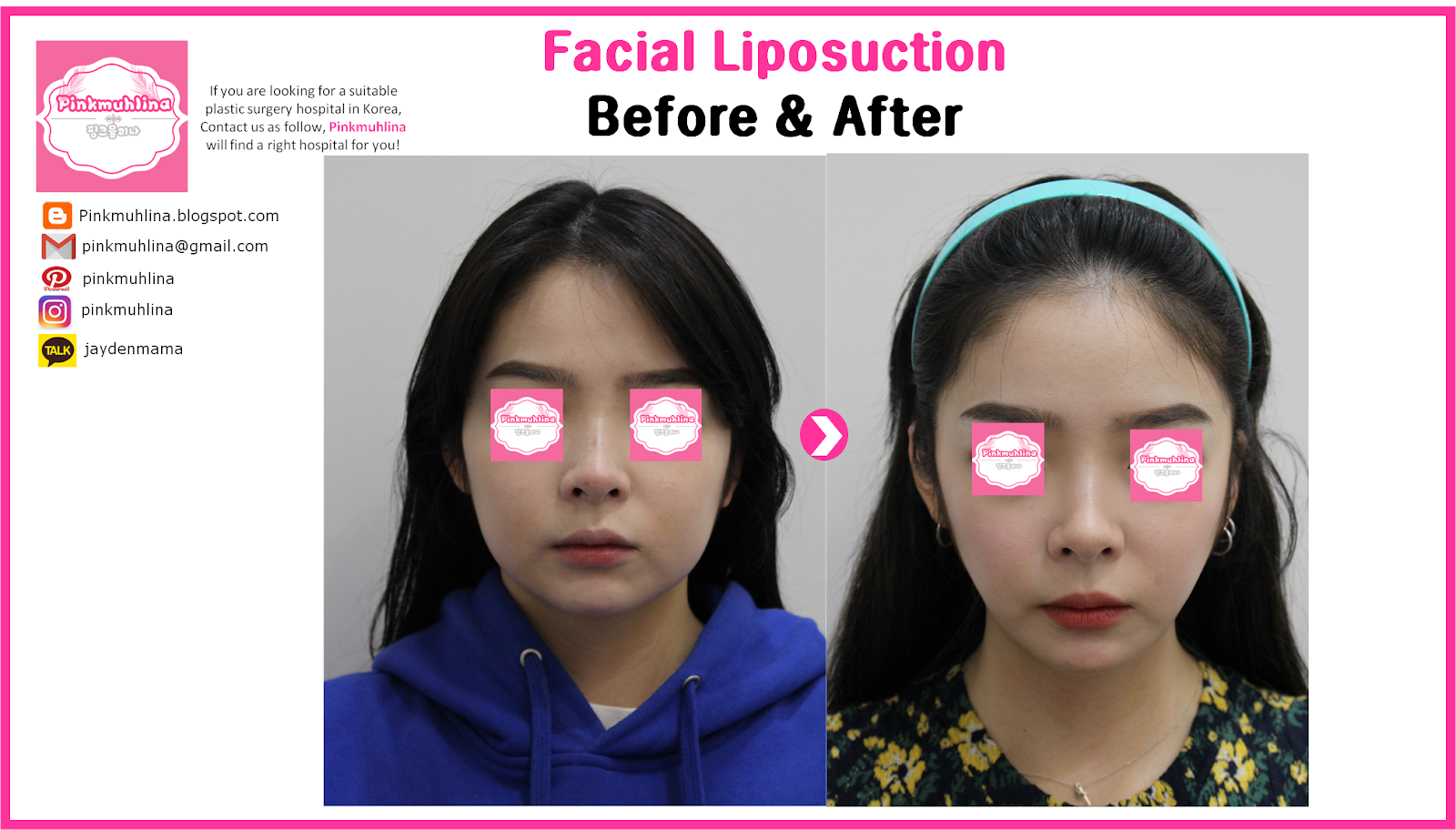 [Pinkmuhlina]Facial Liposuction with VASER2 and BELODY2 before and