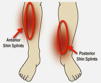 Injured - Posterior Shin Splints - HELP: Triathlon Forum: Slowtwitch Forums