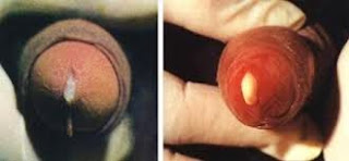 Obat Penyakit Kencing Nanah Obat Penyakit Kencing Nanah