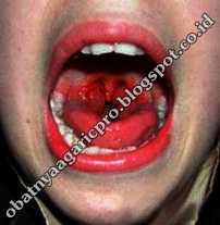 Obat Difteri Obat Difteri