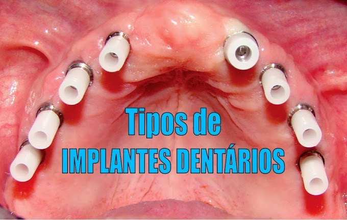 IMPLANTODONTIA: Tipos de Implantes Dentários
