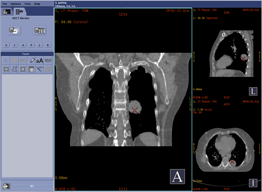 Lung Cancer Treatments For Lung Cancer Stage 3