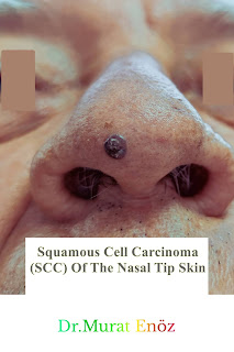 Squamous Cell Carcinoma, SCC, The Nasal Tip Skin Cancer, Nose Tumor