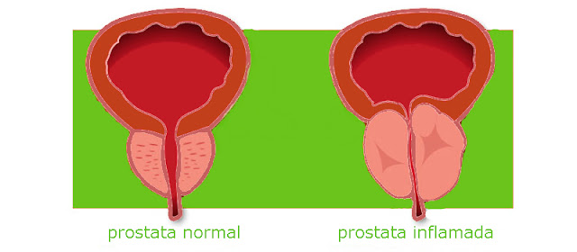 Enfermedades de la prostata. Dprostata