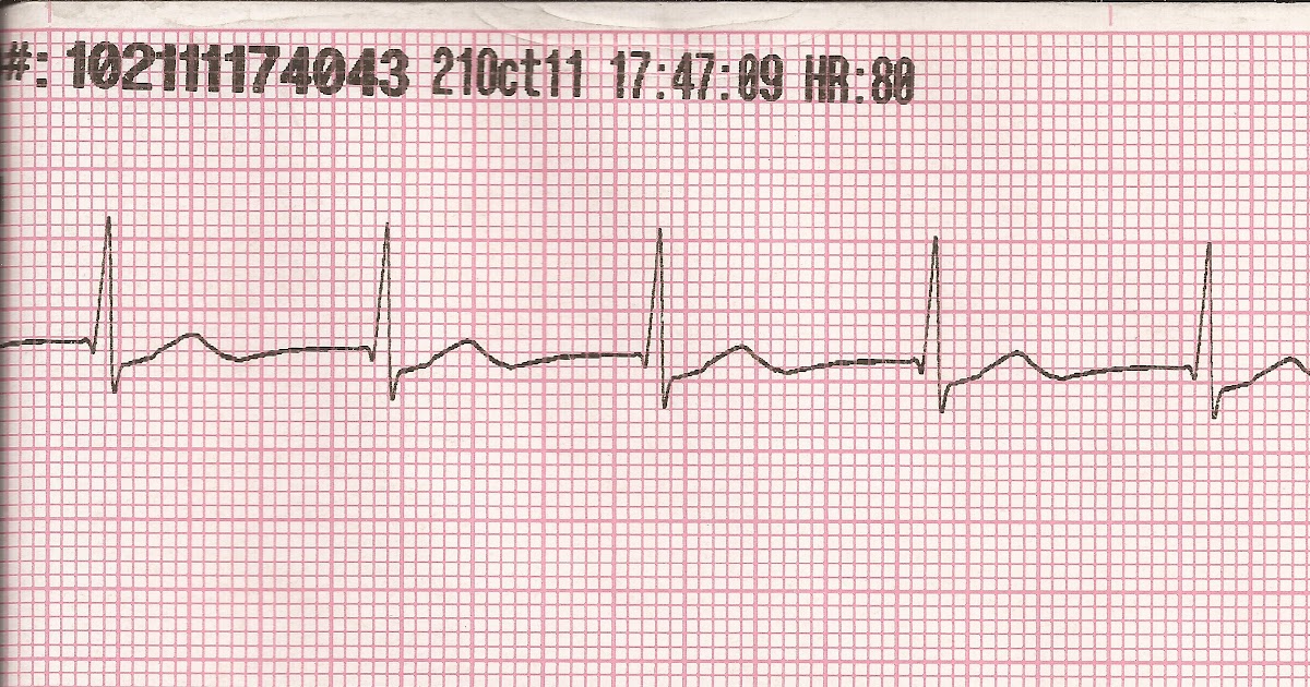 Float Nurse EKG Rhythm Strips 29 Junctional Rhythms